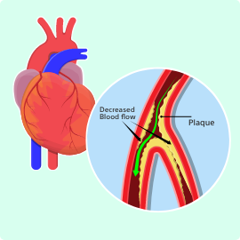 The Importance of Calcium Management in Angioplasty