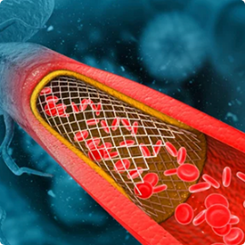 Angioplasty Outcomes