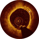 Computed Tomography (CT) Scans