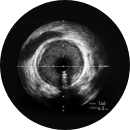 High-Definition Intravascular Ultrasound (HD-IVUS)