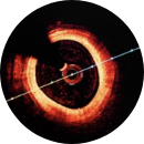 Optical Coherence Tomography (OCT)