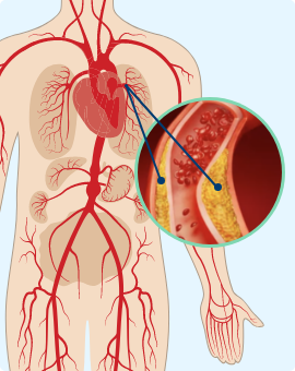 Understanding Arterial Calcium and Its Challenges